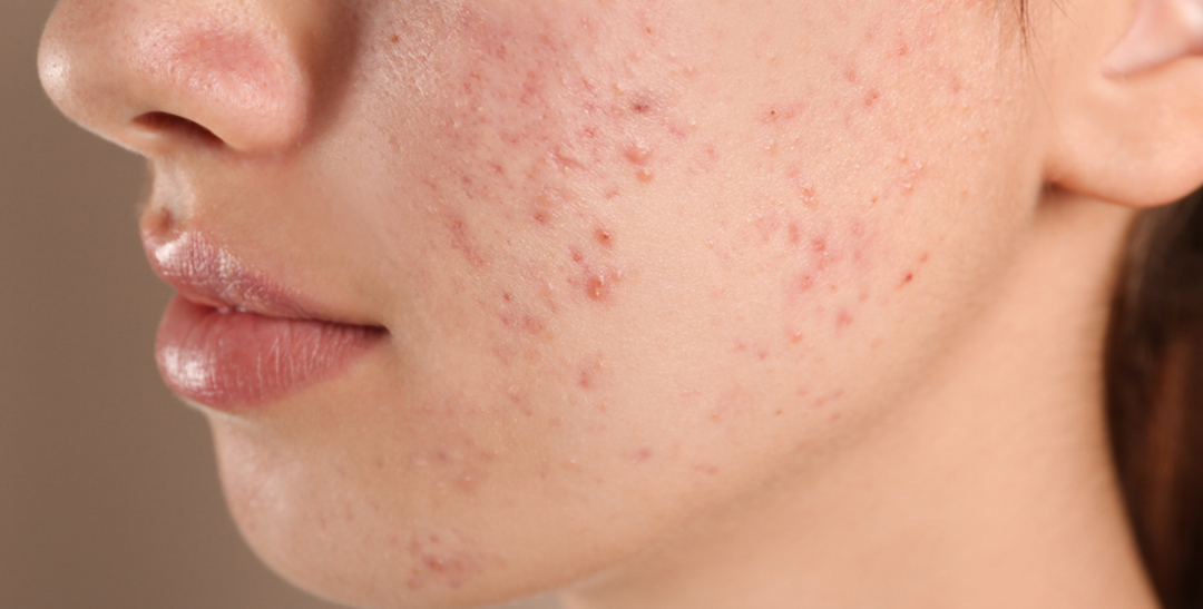 What Is Acne Prone Skin? Causes & Treatments
