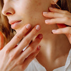 Smart DNA - Acne Profile